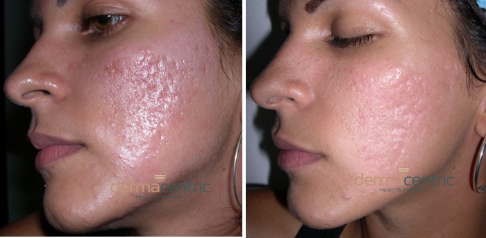 Manejo avanzado de cicatrices