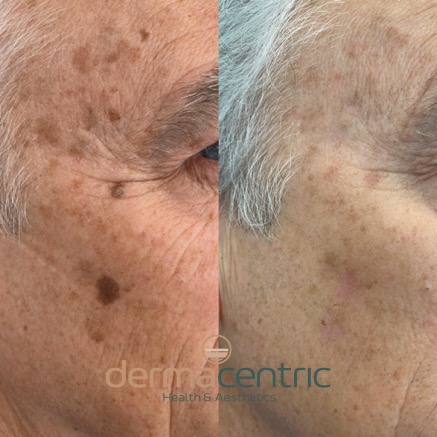 Crioterapia con nitrógeno líquido