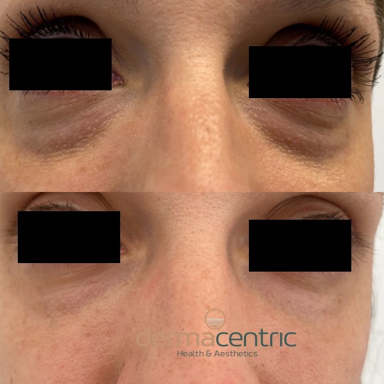 Manejo avanzado de ojeras