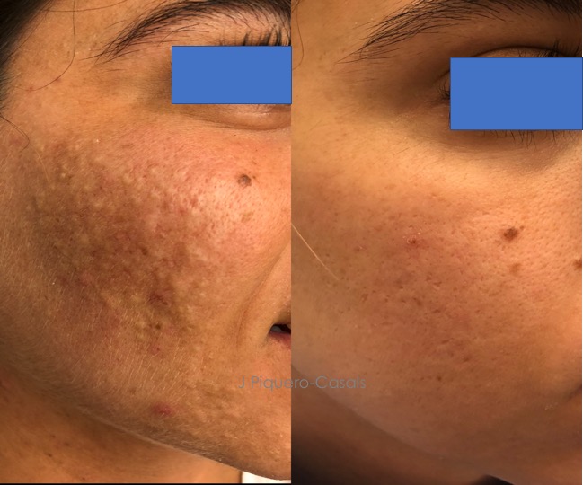 Pieles latinas y fototipos altos